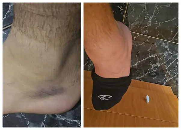 El tobillo tras el accidente y todav&iacute;a hoy