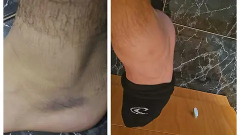 El tobillo tras el accidente y todav&iacute;a hoy